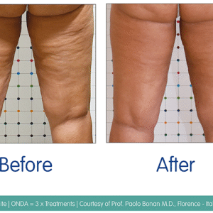 Home cellulite treatments