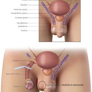 Home orchiectomy consultation