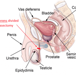 Home vasectomy consultation
